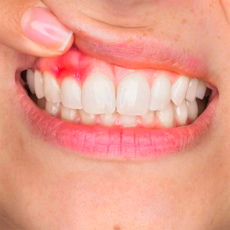 Diş Eti Tedavisi / Periodontoloji