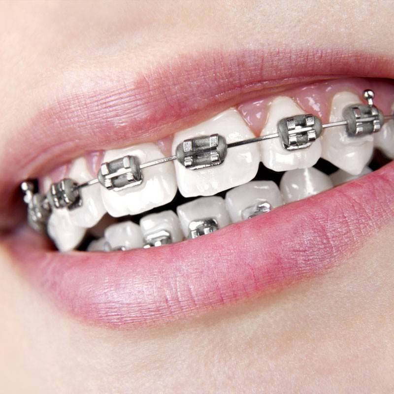 Ortodonti / Diş Teli Tedavisi