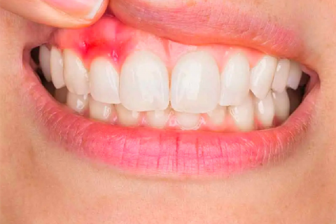 Diş Eti Tedavisi / Periodontoloji